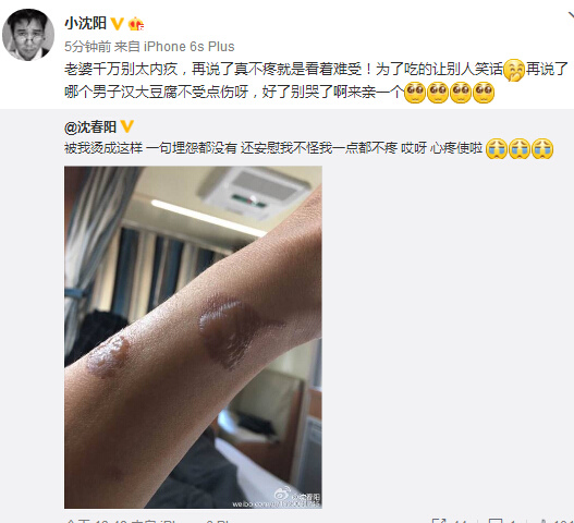 小沈陽被愛妻燙傷手臂起包安慰妻子不要內(nèi)疚