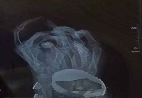 小伙手指斷裂身中“百草枯” 或因前女友報復(fù)