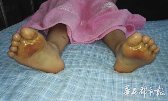 四川多名小學(xué)生37℃高溫下被罰光腳跑遭燙傷